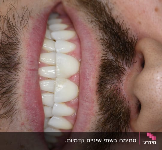 תמונה של שיניים בריאות ומטופחות